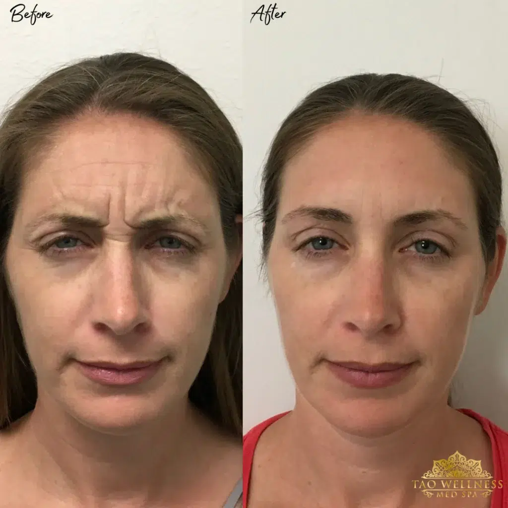 Botox before and after photo by TAO Wellness Med Spa in Tampa, FL