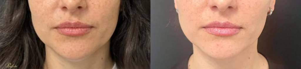 Chin Filler Dissolved before and after photo by TAO Wellness Med Spa in Tampa, FL