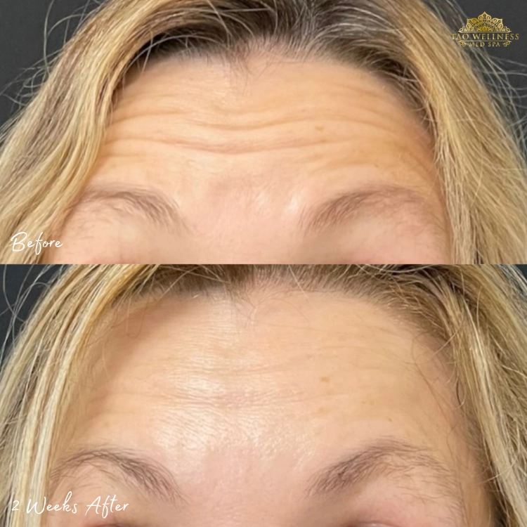 before and after botox treatment at tao wellness medspa