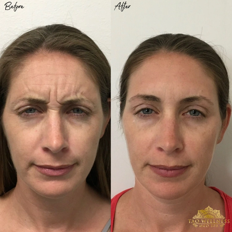 before and after botox treatment at tao wellness medspa