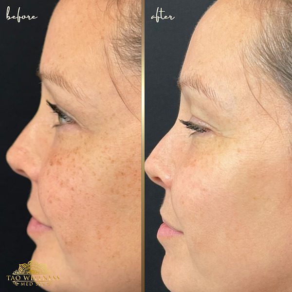 before and after lumecca ipl treatment tao wellness med spa