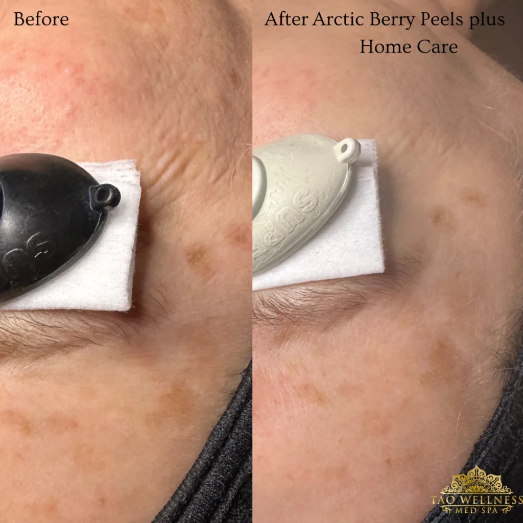 Facials Plus Home Care before and after photo by TAO Wellness Med Spa in Tampa, FL