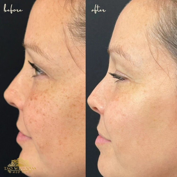 before and after morpheus treatment at tao wellness medspa