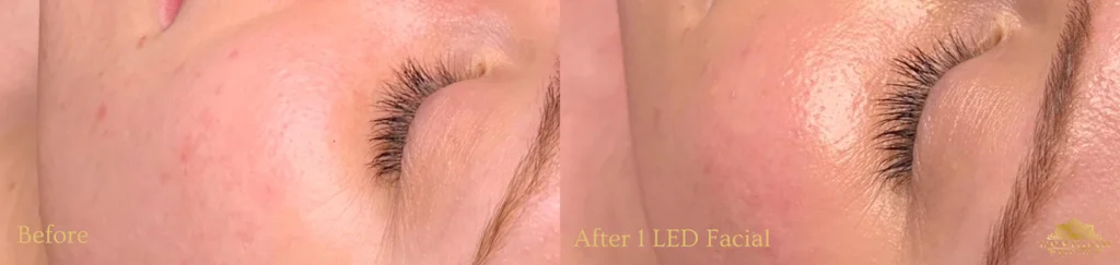 LED Facial before and after photo by TAO Wellness Med Spa in Tampa, FL