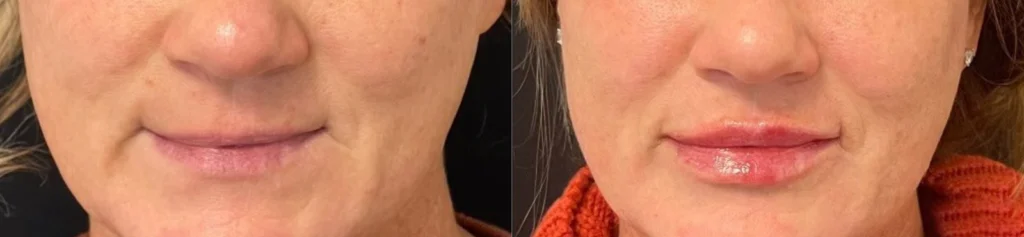 Lip Filler before and after photo by TAO Wellness Med Spa in Tampa, FL