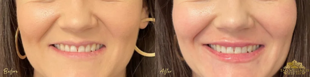 Lip Filler before and after photo by TAO Wellness Med Spa in Tampa, FL