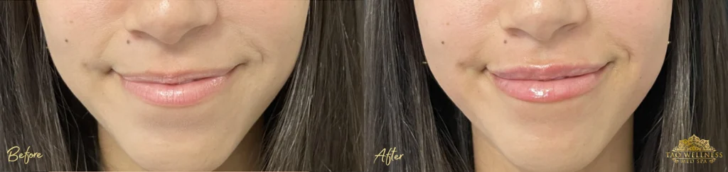 Lip Filler before and after photo by TAO Wellness Med Spa in Tampa, FL