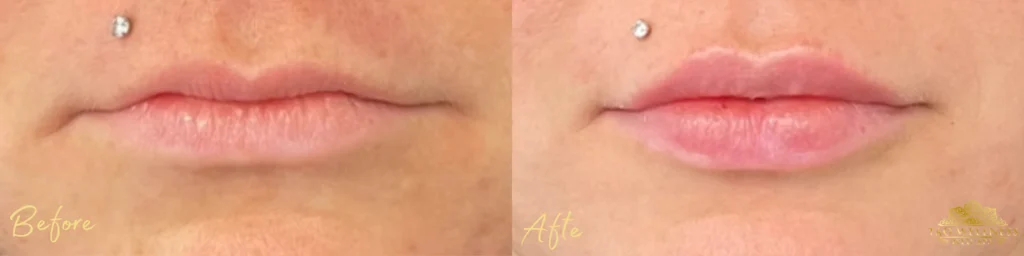 Lip Filler before and after photo by TAO Wellness Med Spa in Tampa, FL