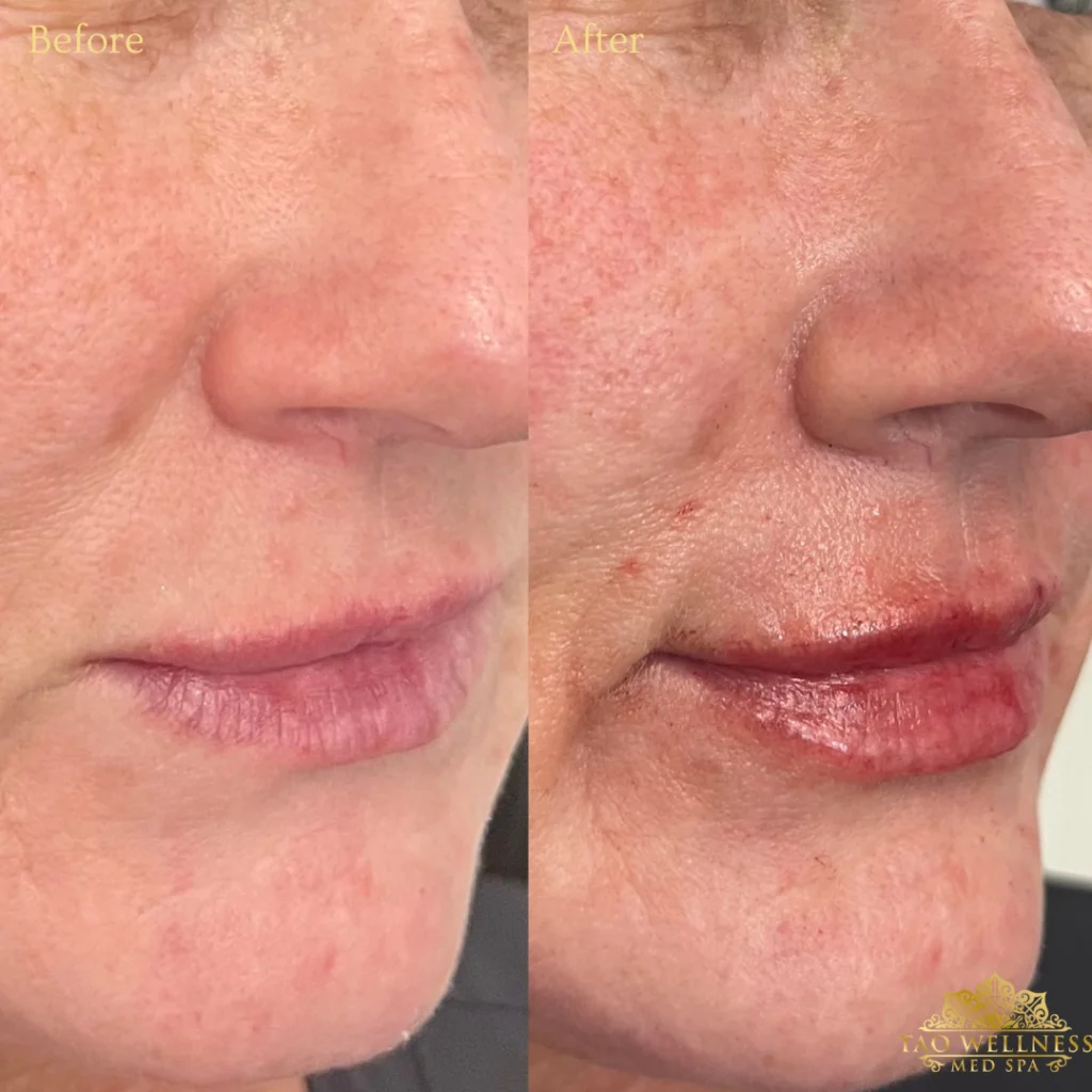 Lip Filler before and after photo by TAO Wellness Med Spa in Tampa, FL