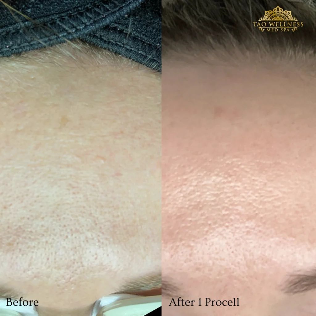 Procell before and after photo by TAO Wellness Med Spa in Tampa, FL