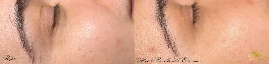 Procell before and after photo by TAO Wellness Med Spa in Tampa, FL