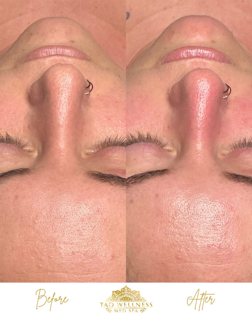 facials before and after photo by tao wellness med spa in tampa fl