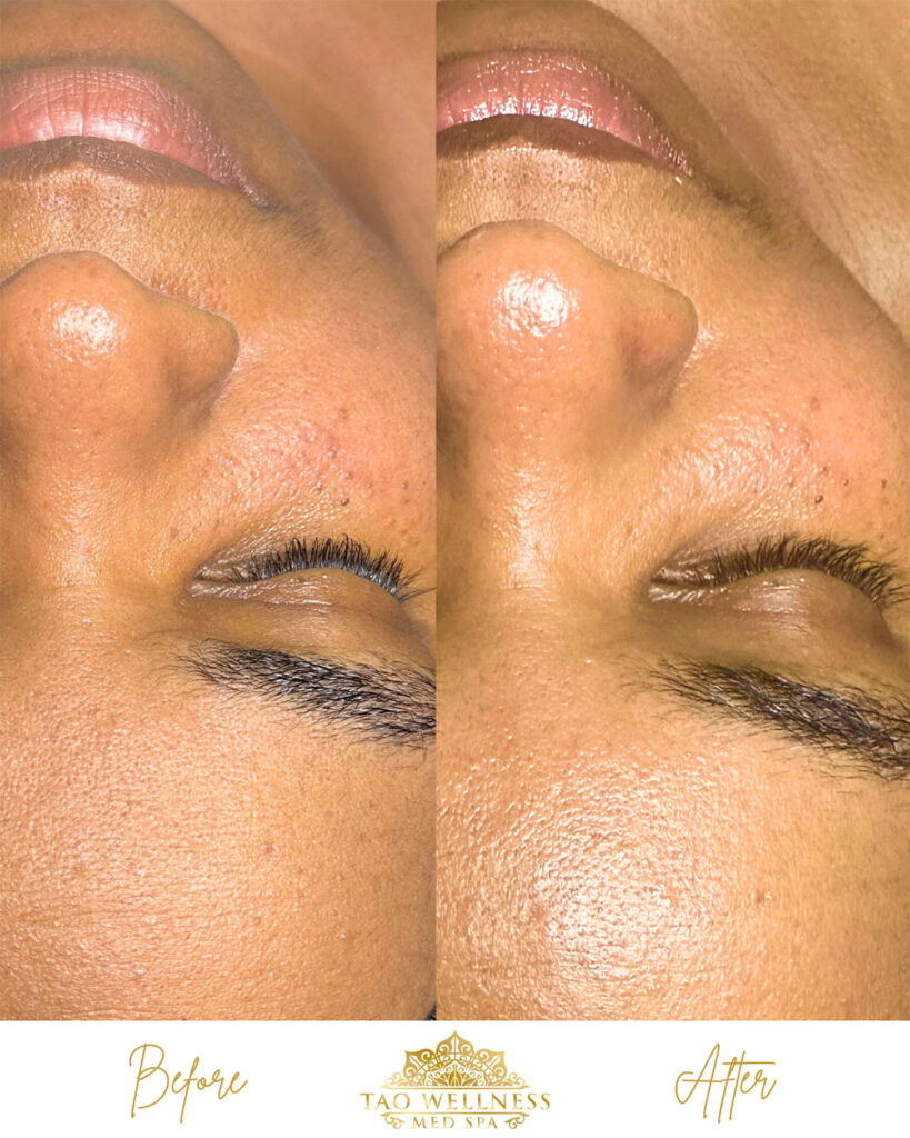 facials before and after photo by tao wellness med spa in tampa fl