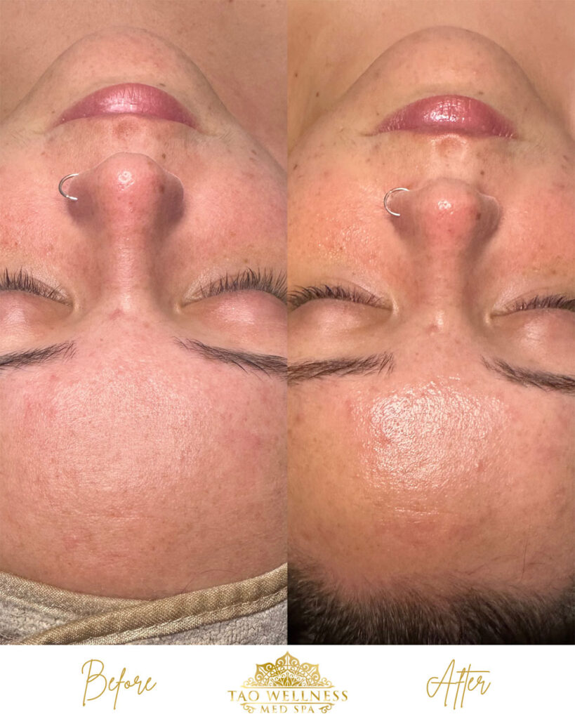 facials before and after photo by tao wellness med spa in tampa fl