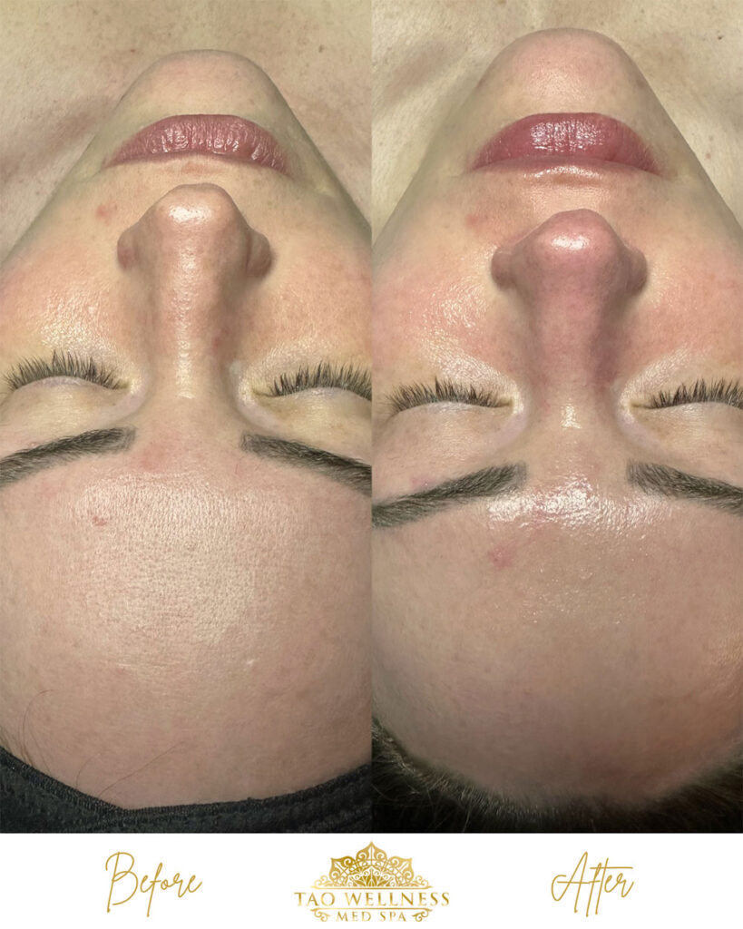 facials before and after photo by tao wellness med spa in tampa fl