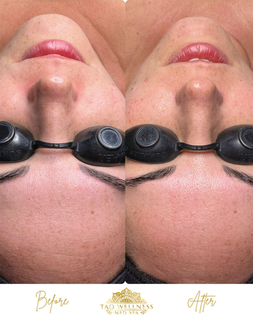 procell before and after photo by tao wellness med spa in tampa fl