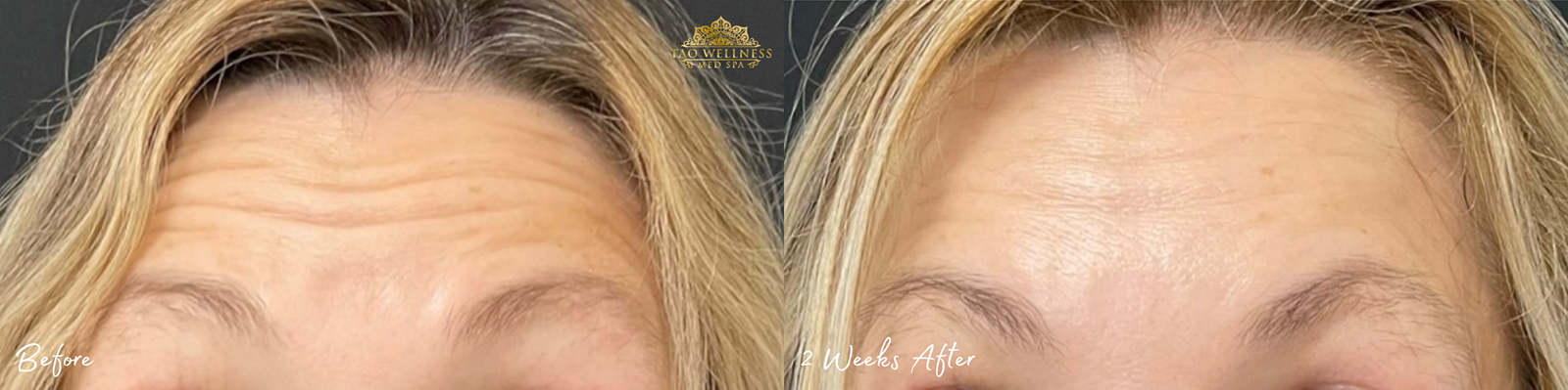 botox before and after photo by tao wellness med spa in tampa fl