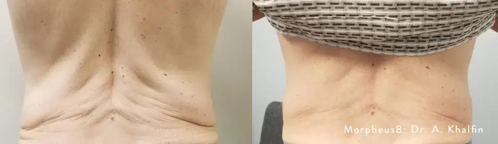 Skin tightening results with Morpheus8 treatment lower back