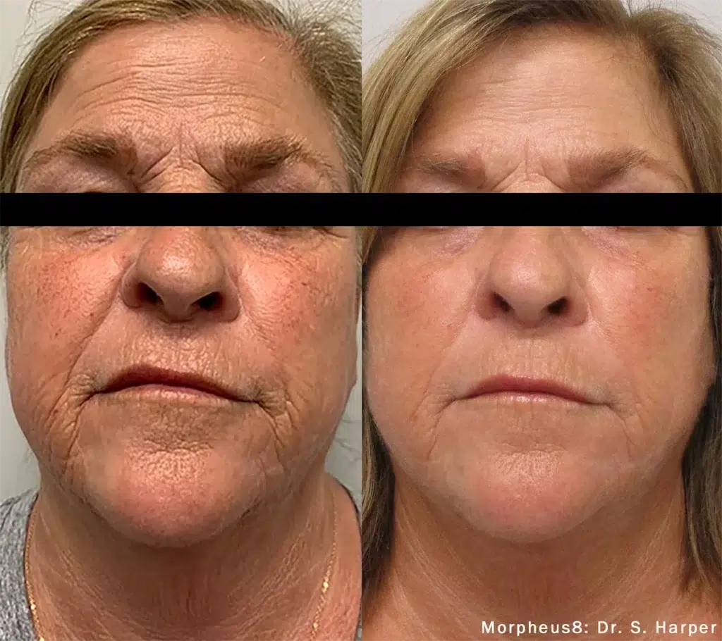 Morpheus8 before and after showing smoother youthful skin