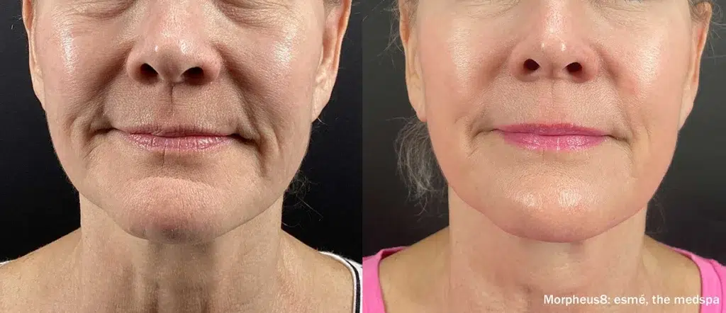 Morpheus8 before and after face contouring treatment