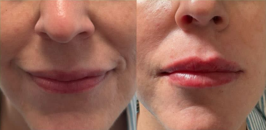 morpheus before and after photo by tao wellness med spa in tampa fl