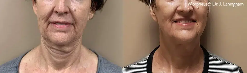Morpheus8 before and after neck and jawline tightening