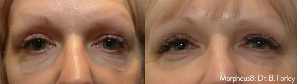 Morpheus8 before and after under eye skin tightening
